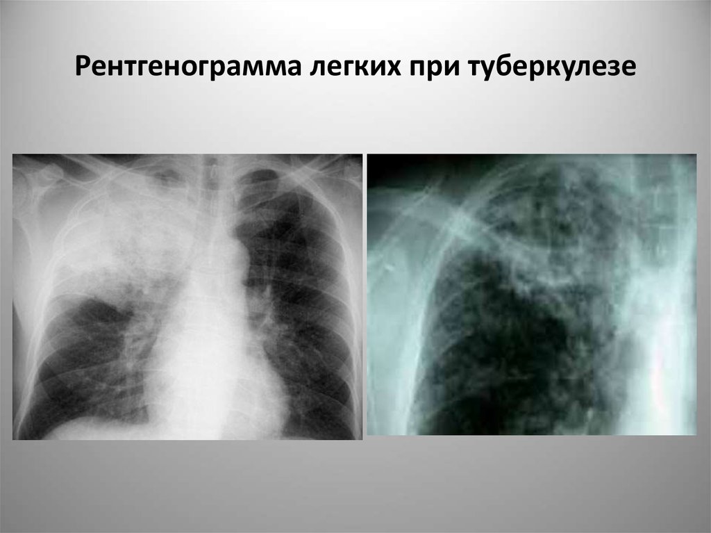 Туберкулез легкого рентгенограмма. Рентген легких туберкулез снимки. Легкие туберкулез рентген. Туберкулёз лёгких рентген снимок. Туберкулез легких рентген.