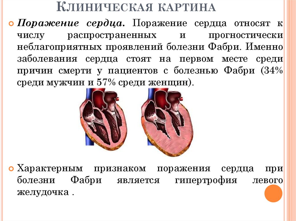 Преимущественное поражение сердца без застойной сердечной. Клиническая картина болезни Фабри. Поражение сердца болезнь Фабри.