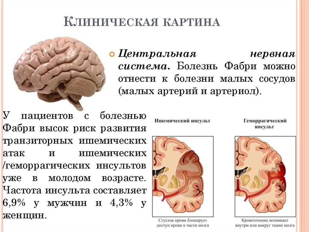 Болезнь фабри клиническая картина