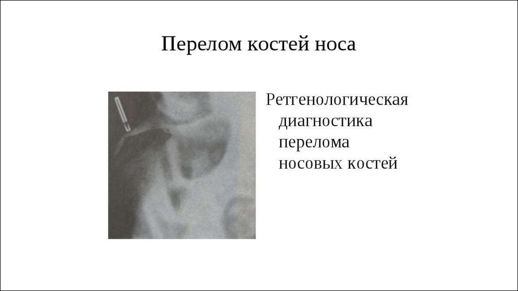 Рак полости носа и придаточных пазух презентация