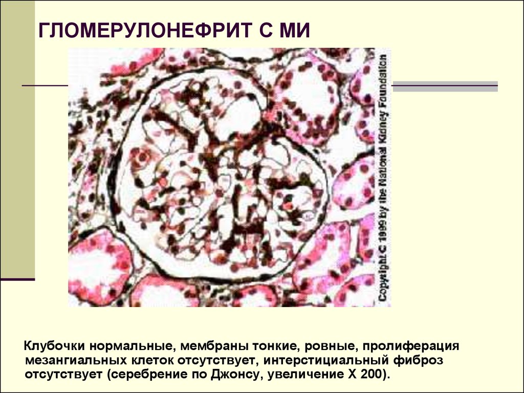 Гломерулонефрит хронический картинки