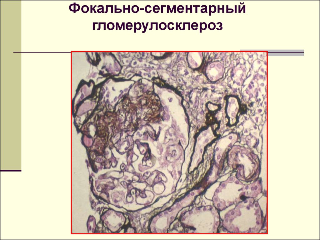 Гломерулонефрит хронический картинки