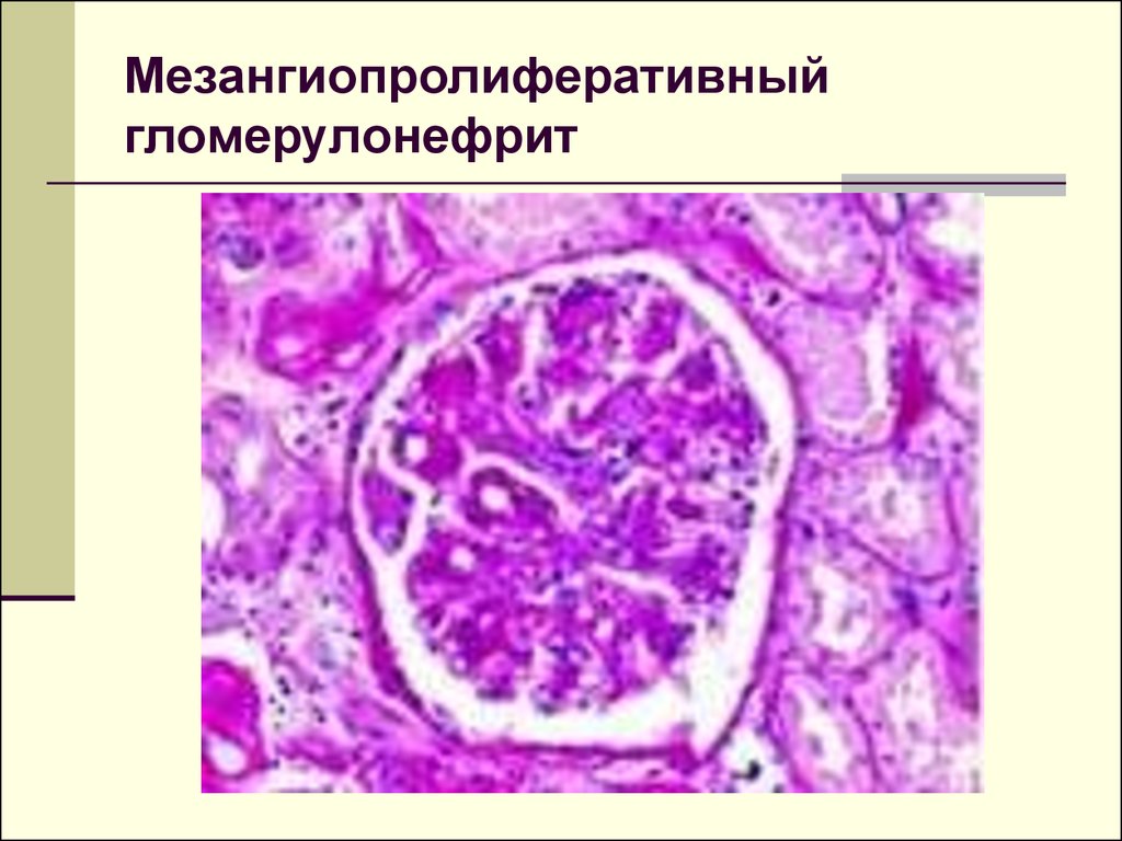 Морфологическая картина гломерулонефрита