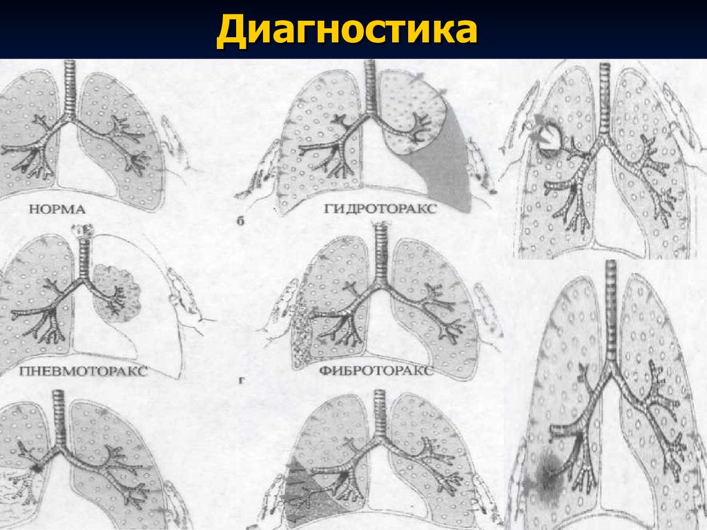 Гидроторакс карта. Сухой плеврит пневмоторакс. Сухой плеврит схема.