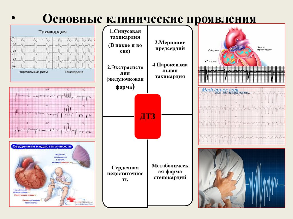 Тахикардия в покое. ЭКГ при диффузном токсическом зобе. Клинические проявления ДТЗ. Тиреотоксический зоб важные клинические симптомы. ЭКГ при зобе.