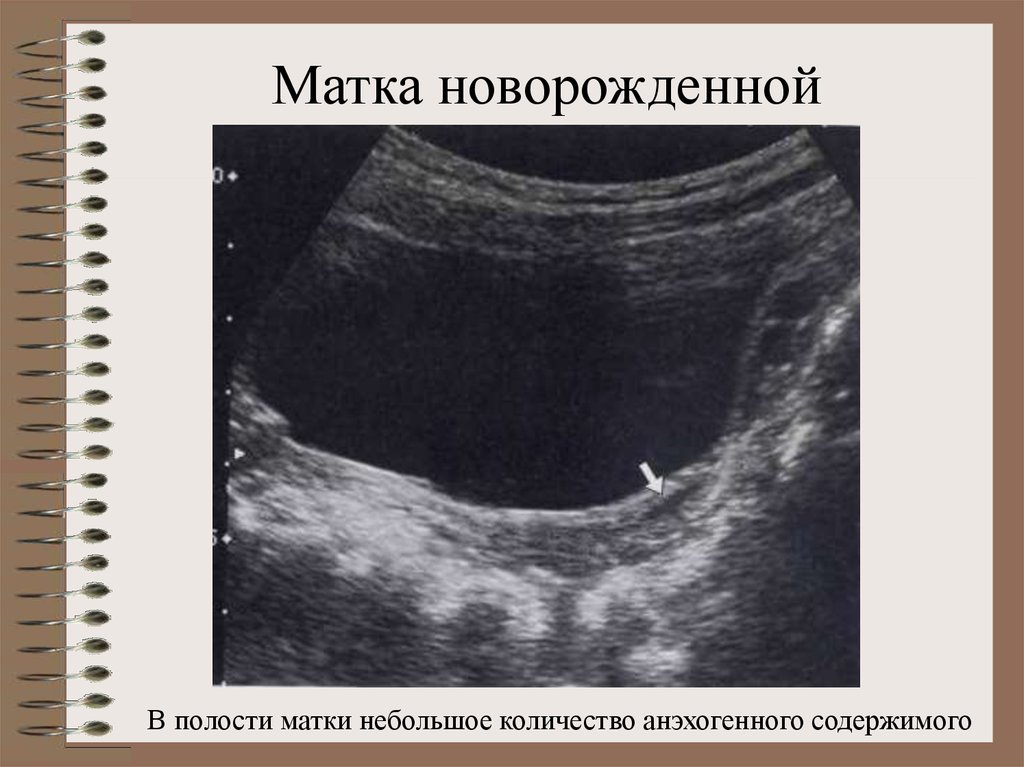 Расширенная полость матки с анэхогенным содержимым