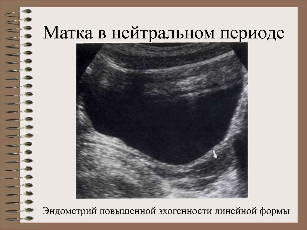 Почему может быть увеличена матка. Эхогенность эндометрия. Эндометрия повышенной эхогенности что это. Эндометрий повышенной эхогенности. Структура эндометрия однородная.