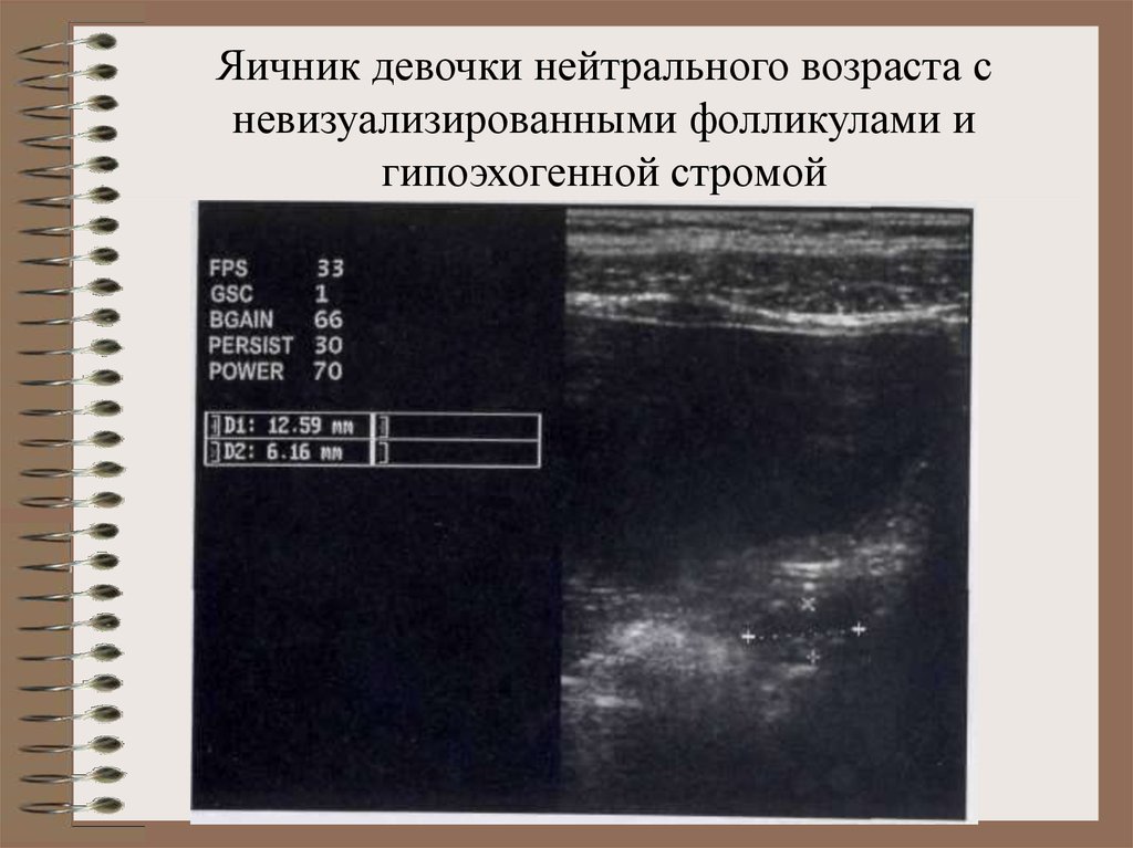 Диагностика возраста. Гипоэхогенные образования яичника у женщин. Гипоэхогенная бляшка. Гипоэхогенное включение в яичнике.