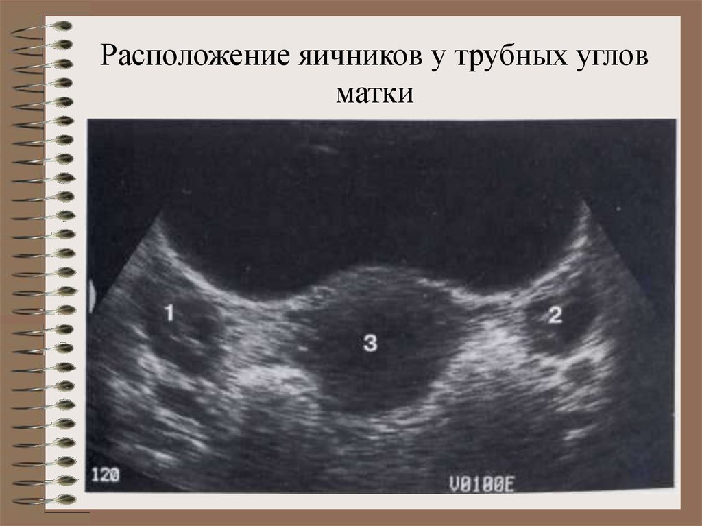 Где матка и яичники. Расположение яичников. Левый яичник расположение. Правый яичник расположение.