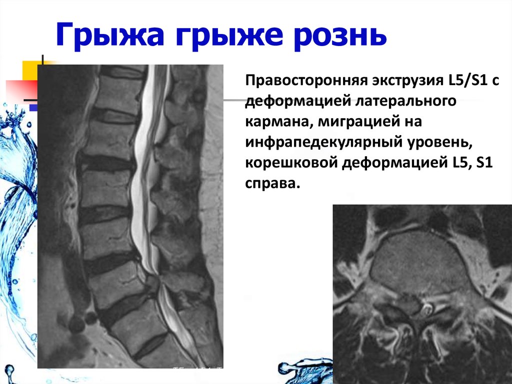 Экструзия с каудальной миграцией