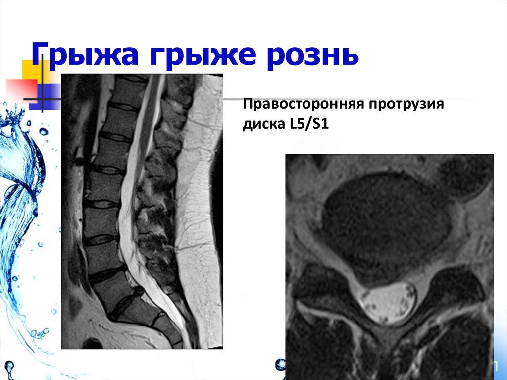 Экструзия позвоночника. Протрузия экструзия. Протрузия и грыжа. Экструзия это грыжа.