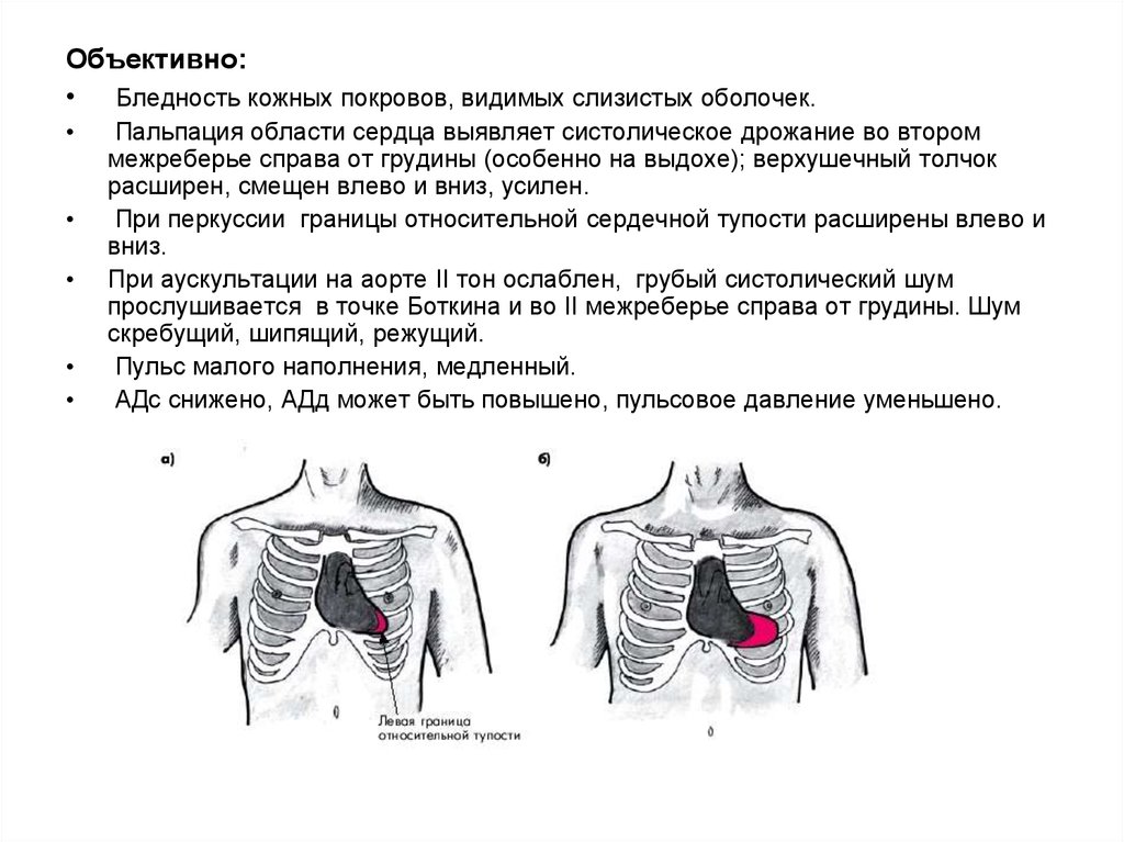 Межреберная невралгия карта вызова