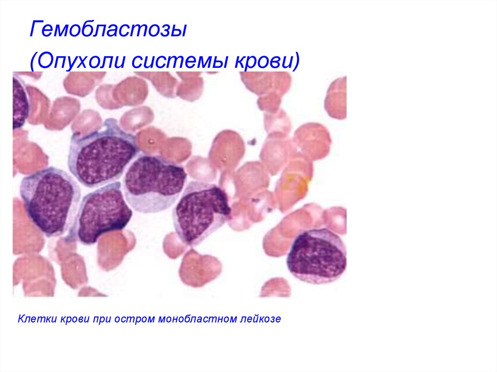 Гемобластозы это. Опухоли системы крови (гемобластозы).. Опухоли системы крови гемобластозы патанатомия. Картина крови при монобластном лейкозе. Первично-локальные гемобластозы.