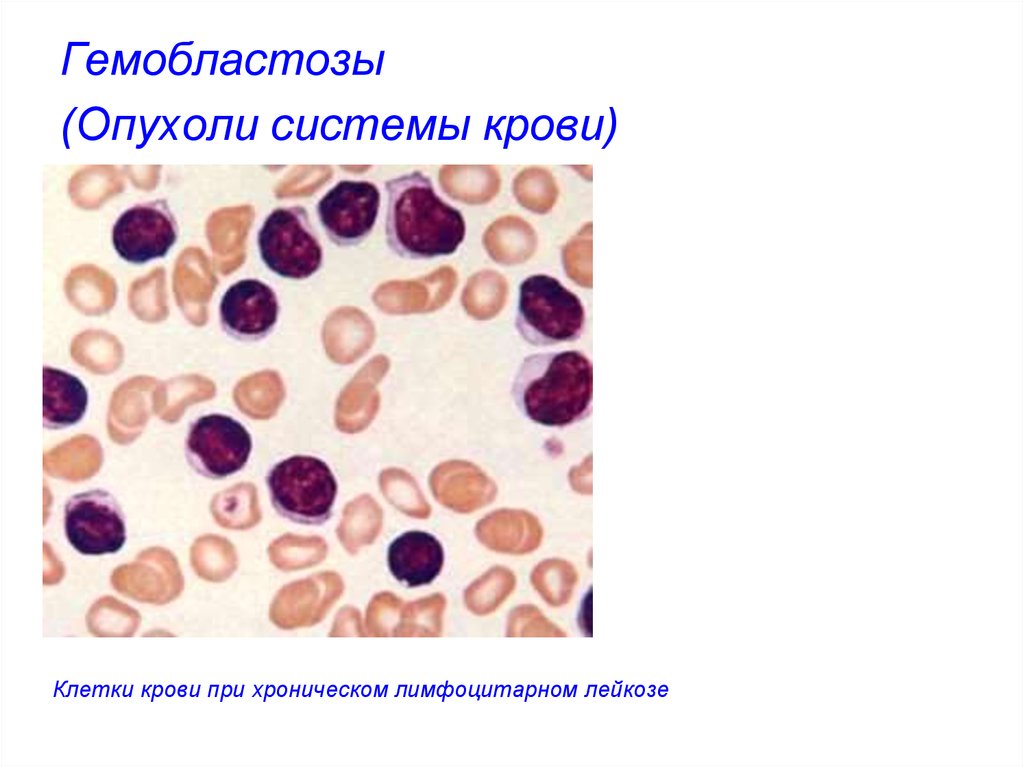 Гемобластозы это. Опухоли системы крови патанатомия. Гемобластозы классификация патанатомия. Опухоли системы крови (гемобластозы).. Острый лимфобластный лейкоз мазок.