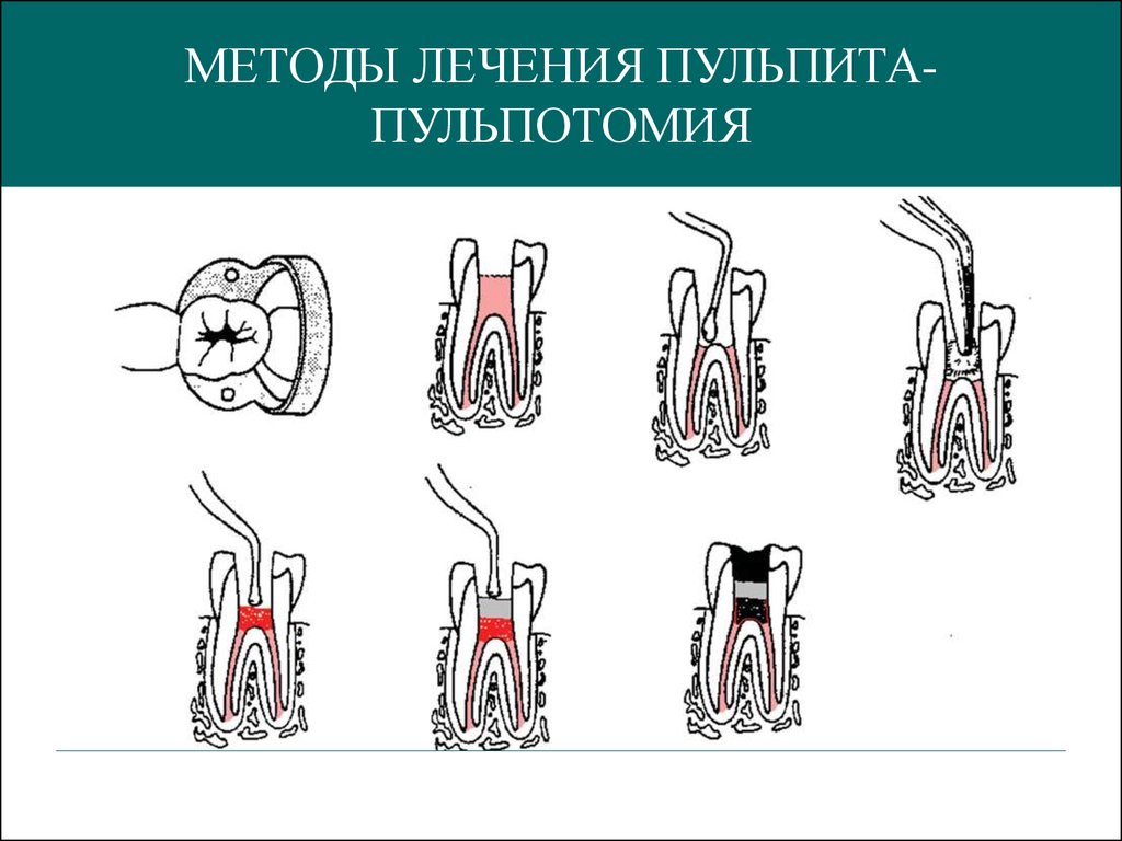 Пульпит временных и постоянных зубов у детей презентация