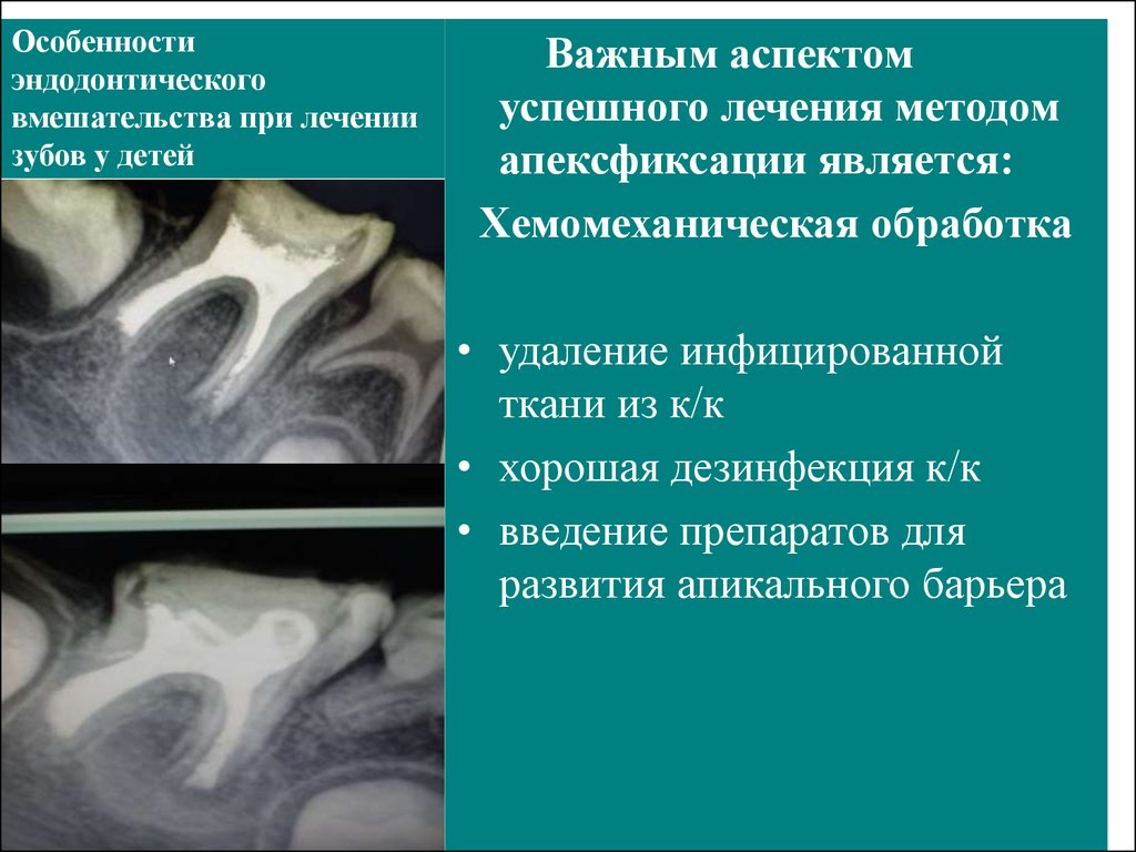 Осложнения эндодонтического лечения. Пульпит временных зубов презентация. Острый пульпит временных зубов. Апексогенез и апексификация. Острый пульпит временных зубов у детей.