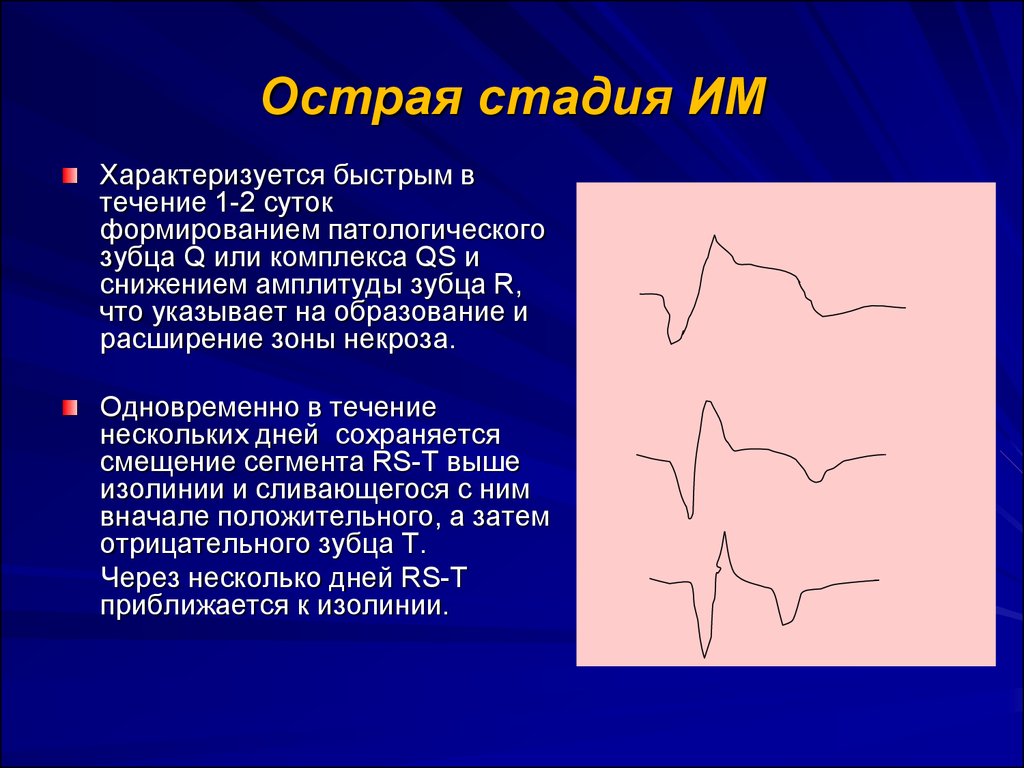 Патологический зубец q при инфаркте. Механизм формирования патологического зубца q. Острая стадия им. Острая стадия инфаркта. Острейшая стадия им.