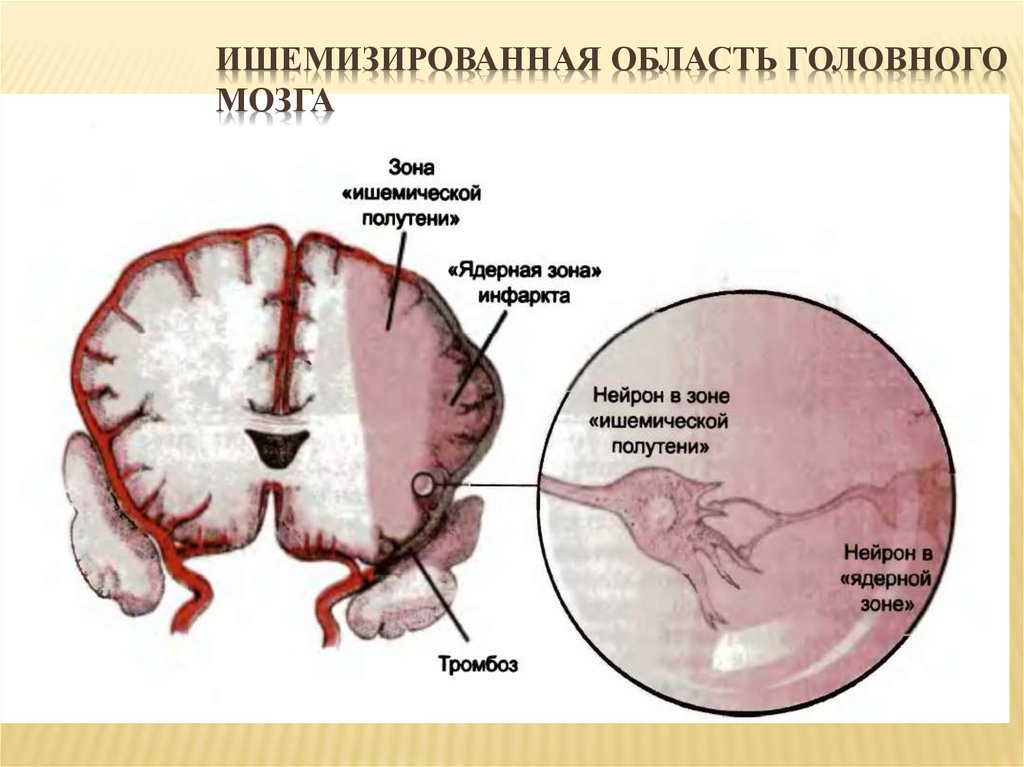 Причины гипоксии мозга