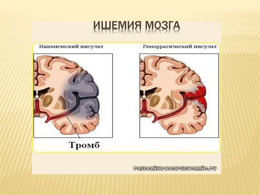 Болезнь ишемия мозга. Ишемия мозга. Ишемическое поражение мозга. Ишемия головного мозга симптомы.