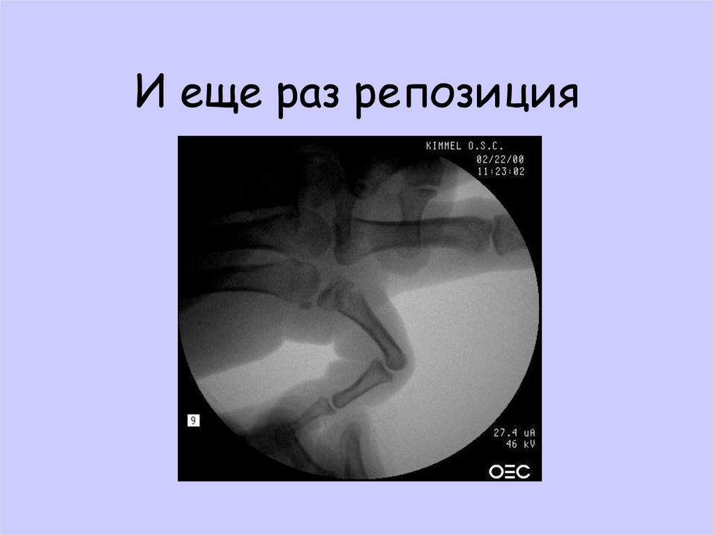 И еще раз репозиция