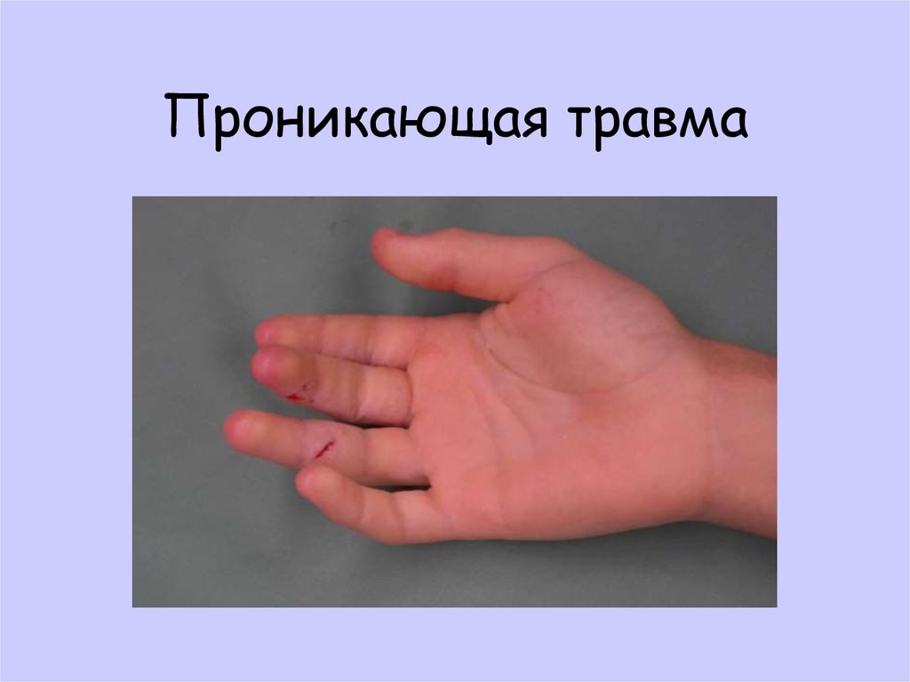 Проникающая травма