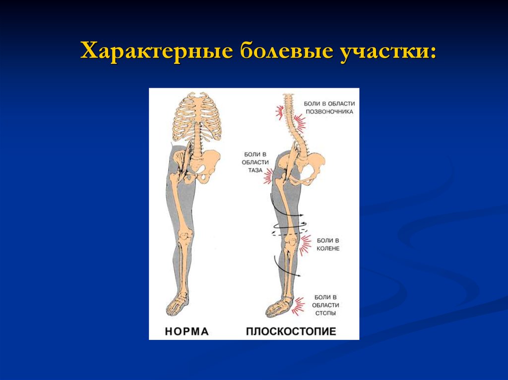 Плоскостопие и позвоночник. Плоскостопие типичные болевые участки. Плоскостопие и искривление позвоночника. Травматология для презентации. Плоскостопие и Кривой таз.