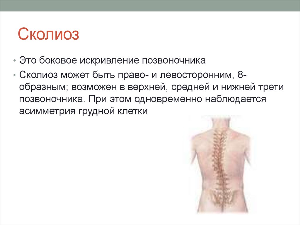 Сколиоз картинки для презентации