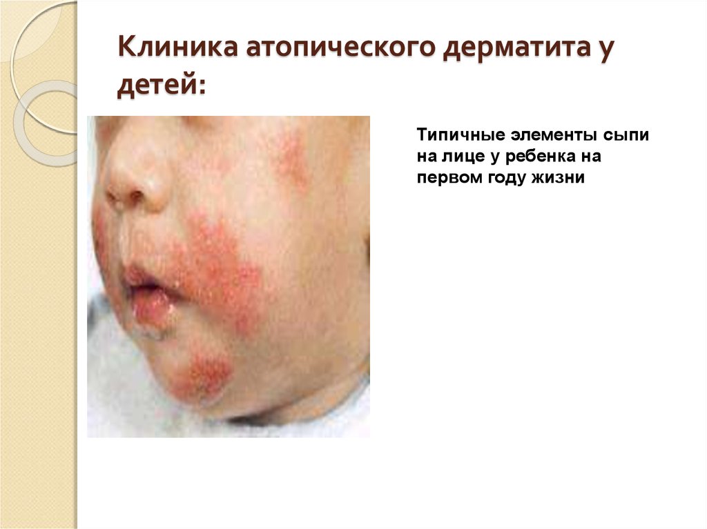 Клиника атопического дерматита у детей: