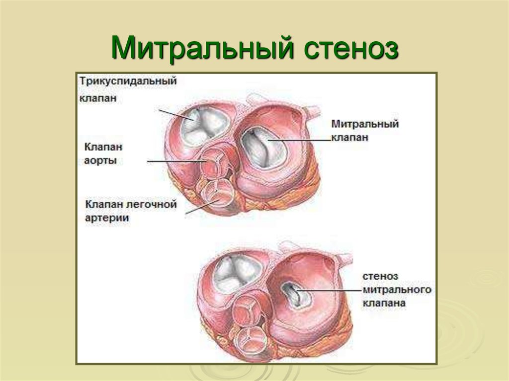 Сочетанный порок митрального клапана презентация