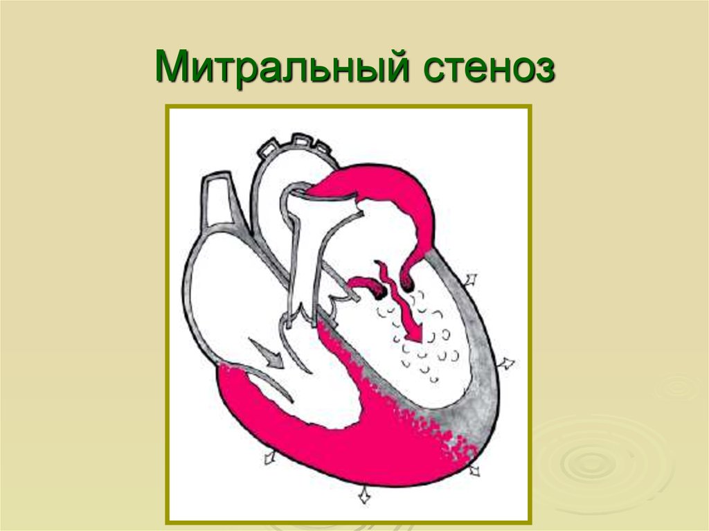 Митральный стеноз. Стеноз митрального клапана гемодинамика схема. Стеноз и недостаточность митрального клапана. Митральный стеноз гемодинамика схема. Митральный стеноз и недостаточность.