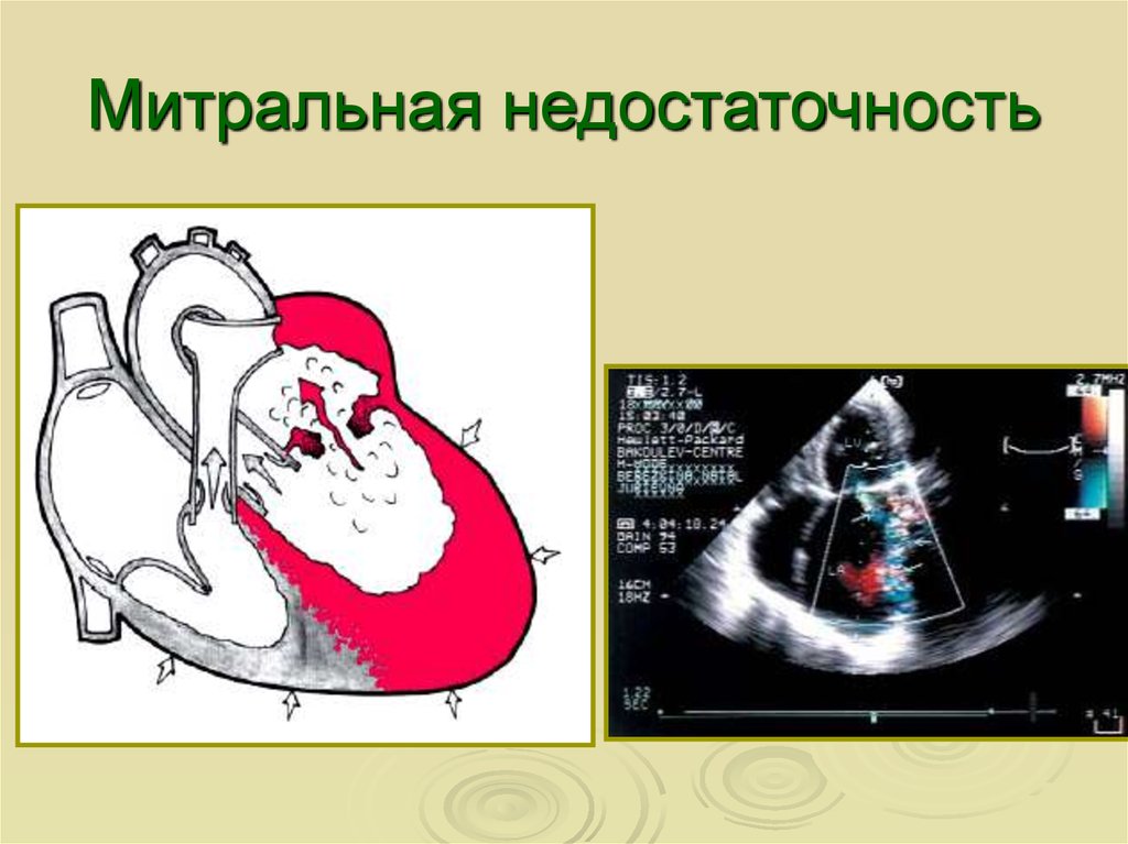 Патогенез митральной недостаточности схема