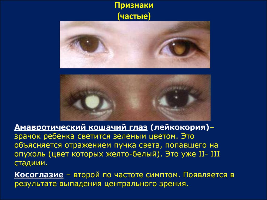 Появился почему появился симптом. Зрачок кошачий глаз признак биологической. Симптом кошачьего зрачка. Симптом кошачьего глаза это признак.