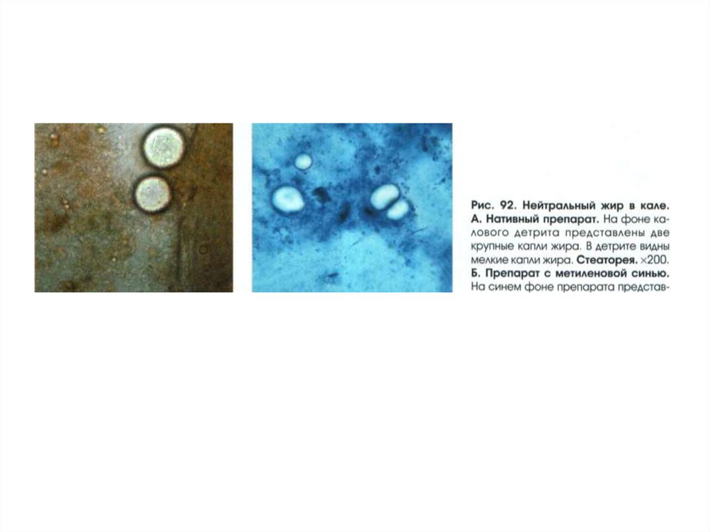 Жирные кислоты в большом количестве в кале. Нейтральный жир в Кале под микроскопом. Микроскопия кала нейтральный жир. Капли нейтрального жира в Кале. Микроскопия кала с метиленовым синим.