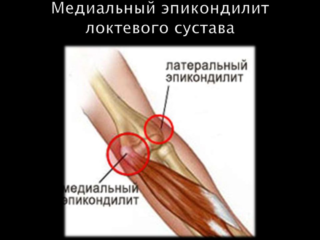 Медиальный надмыщелок плечевой кости. Латеральный надмыщелок локтевого сустава. Медиальный сухожилия локтевого сустава. Медиального надмыщелка локтевого сустава. Наружный эпикондилит локтевого сустава анатомия.