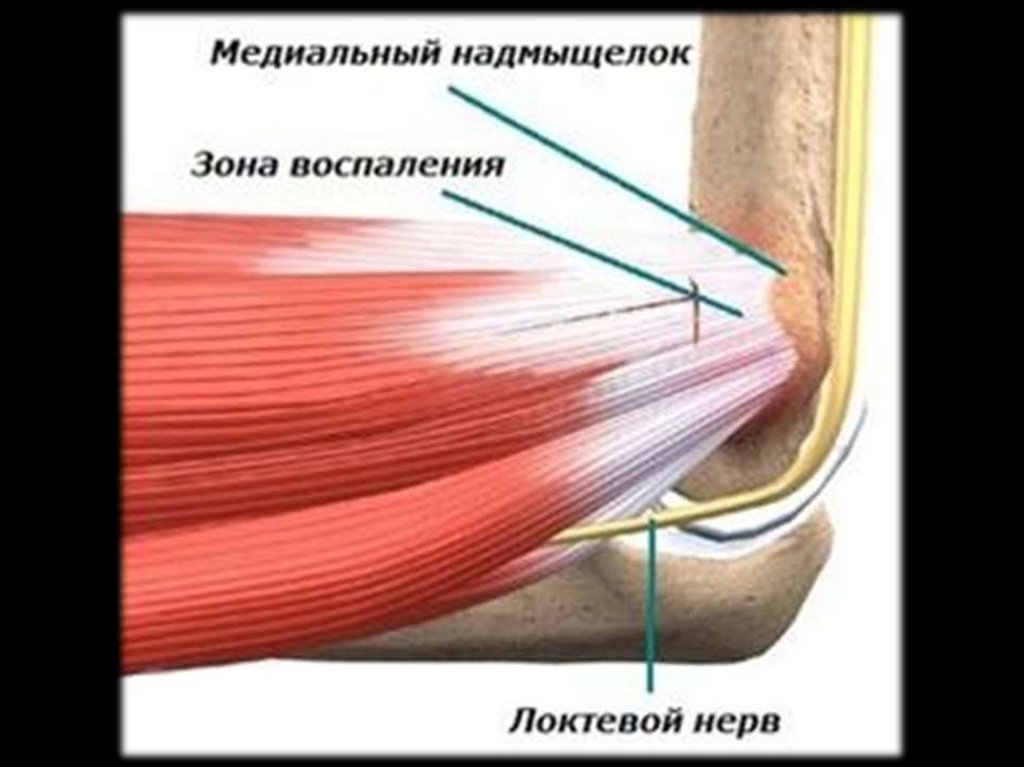 Эпикондилит. Медиальный эпикондилит локтевого. Медиальный эпикондилит сухожилия. Наружный эпикондилит локтевого сустава анатомия. Медиальный эпикондилит локтевого сустава симптомы.