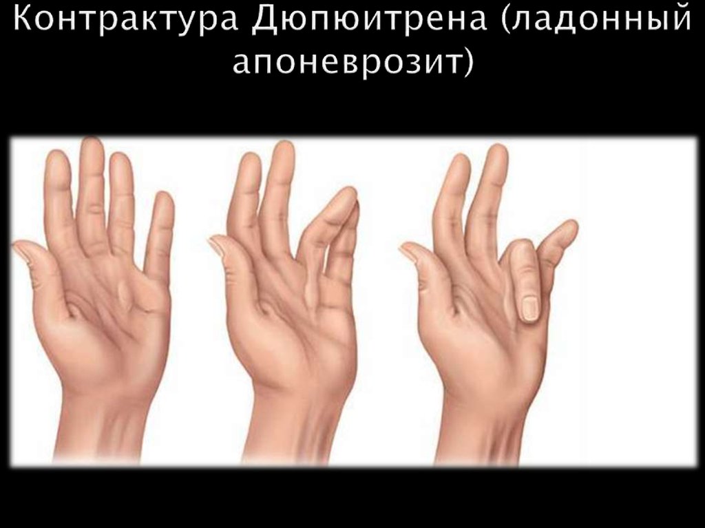 Контрактура Дюпюитрена (ладонный апоневрозит)