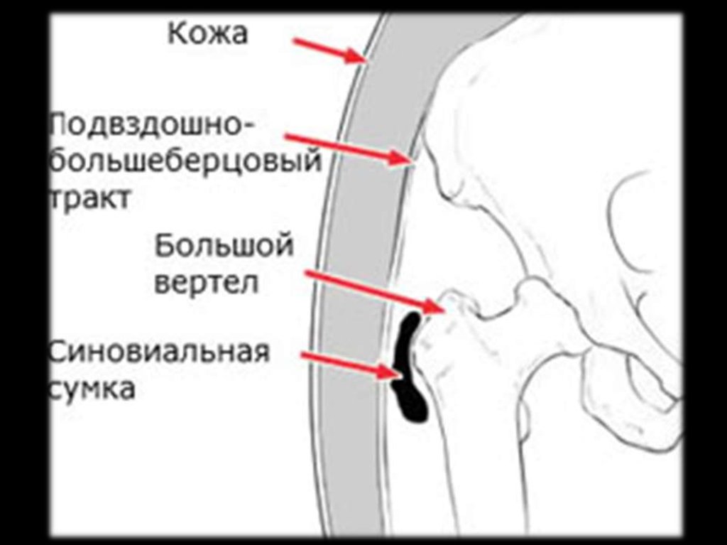 Бурсит тазобедренного сустава симптомы и лечение. Большой вертел бедренной кости синовиальные сумки. Вертел тазобедренного сустава. Вертел большой. Большого вертела бедра.