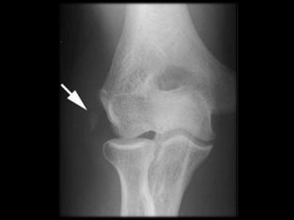 медиальный эпикондилит рентген. латеральный эпикондилит рентген. эпикондилит локтевого сустава рентген. латеральный эпикондилит рентген. латеральный эпикондилит рентген.