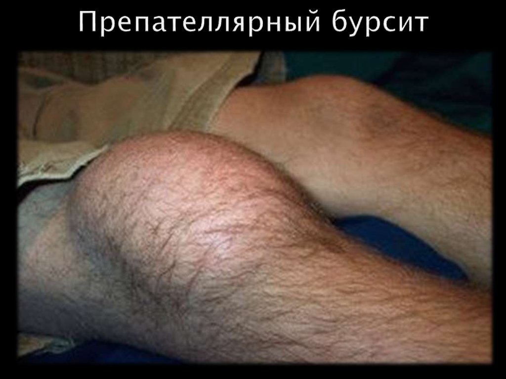 Препателлярный бурсит