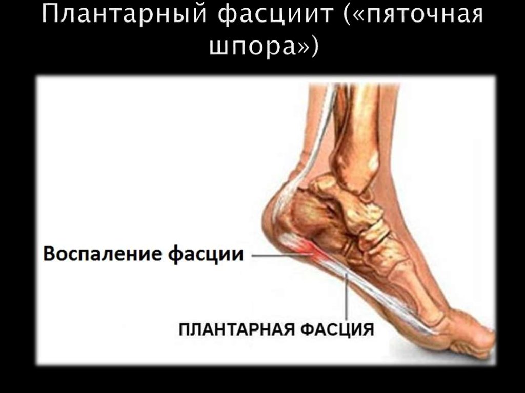 Плантарный фасциит («пяточная шпора»)