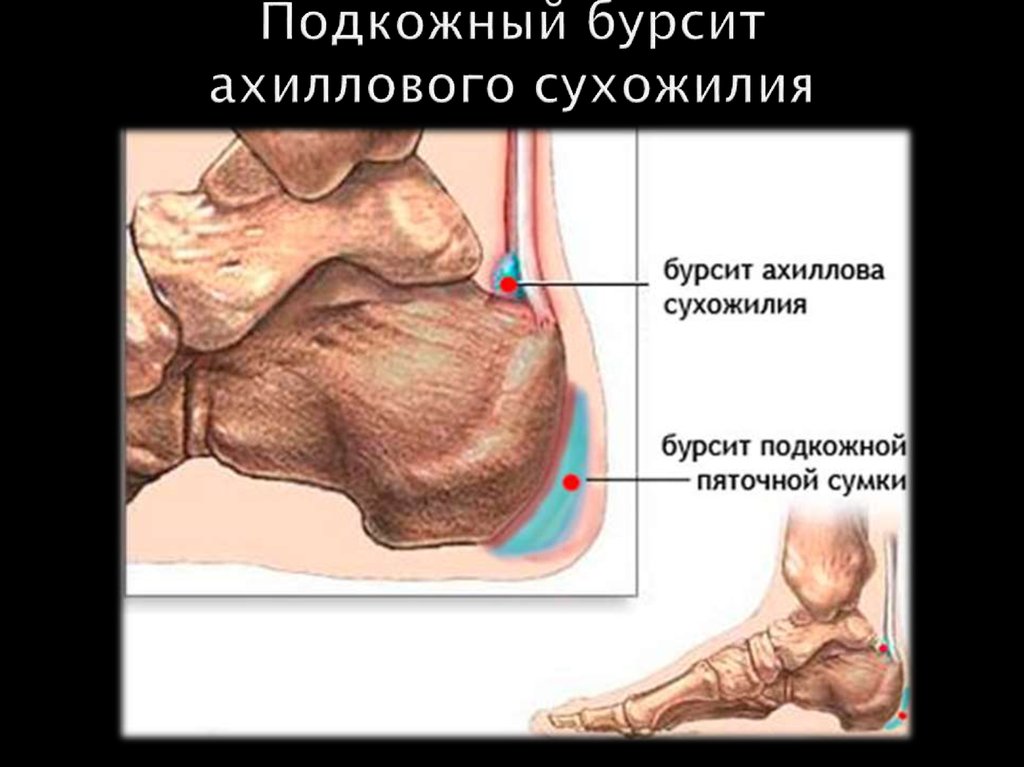 Подкожный бурсит ахиллового сухожилия
