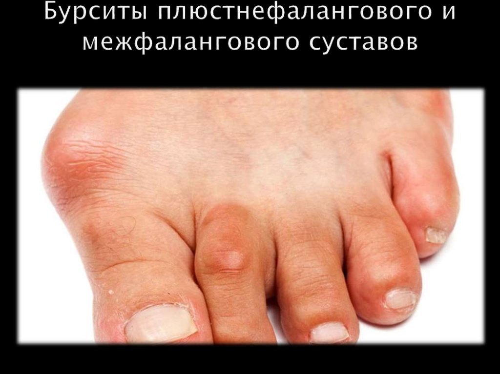 Бурситы плюстнефалангового и межфалангового суставов