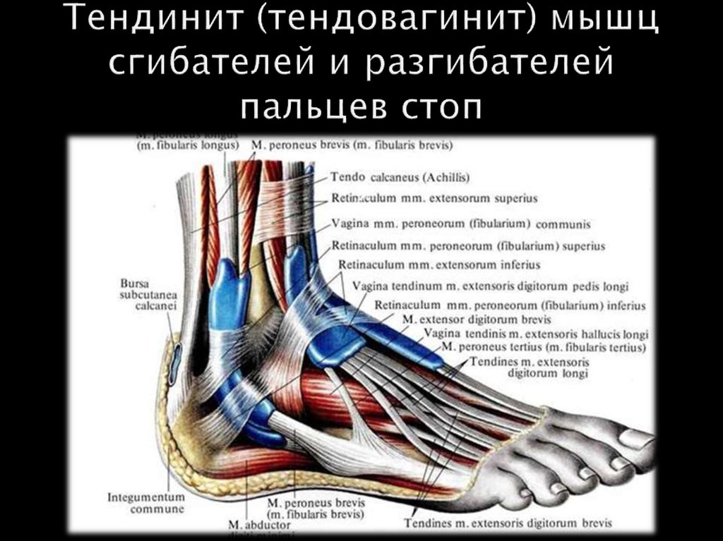 Тендинит (тендовагинит) мышц сгибателей и разгибателей пальцев стоп