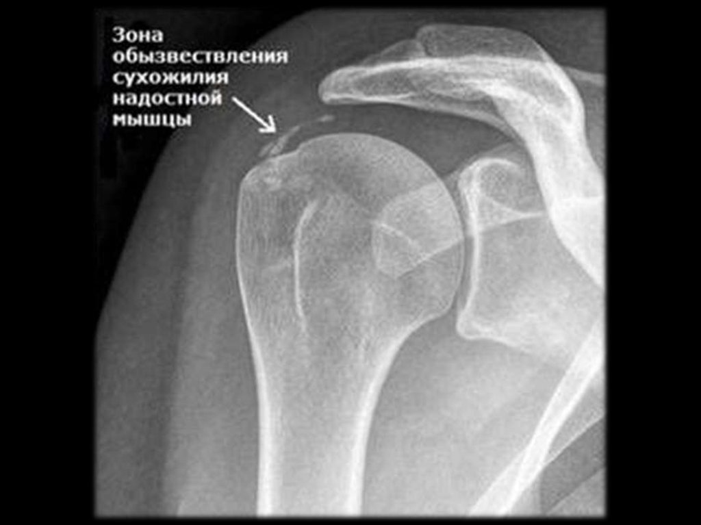 Большой бугорок плечевой кости. Тендиноз надостной мышцы плечевого сустава рентген. Кальцифицирующий тендинит плечевого сустава рентген. Обызвествления плечевого сустава на рентгене. Оссифицирующий бурсит плечевого сустава рентген.