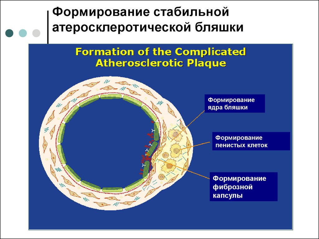 Формирование ядра. Формирование атеросклеротической бляшки. Ядро атеросклеротической бляшки. Стабильная атеросклеротическая бляшка. Главная составная часть атеросклеротической бляшки тест.