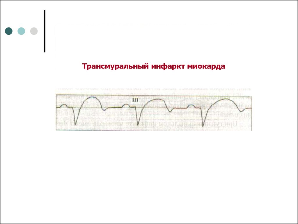 Трансмуральный инфаркт. Трансмуральный инфаркт миокарда. Трансмуральный инфаркт миокарда федеральные клинические. Трансмуральный инфаркт миокарда патогенез. Трансмуральный инфаркт миокарда мгновенная смерть.