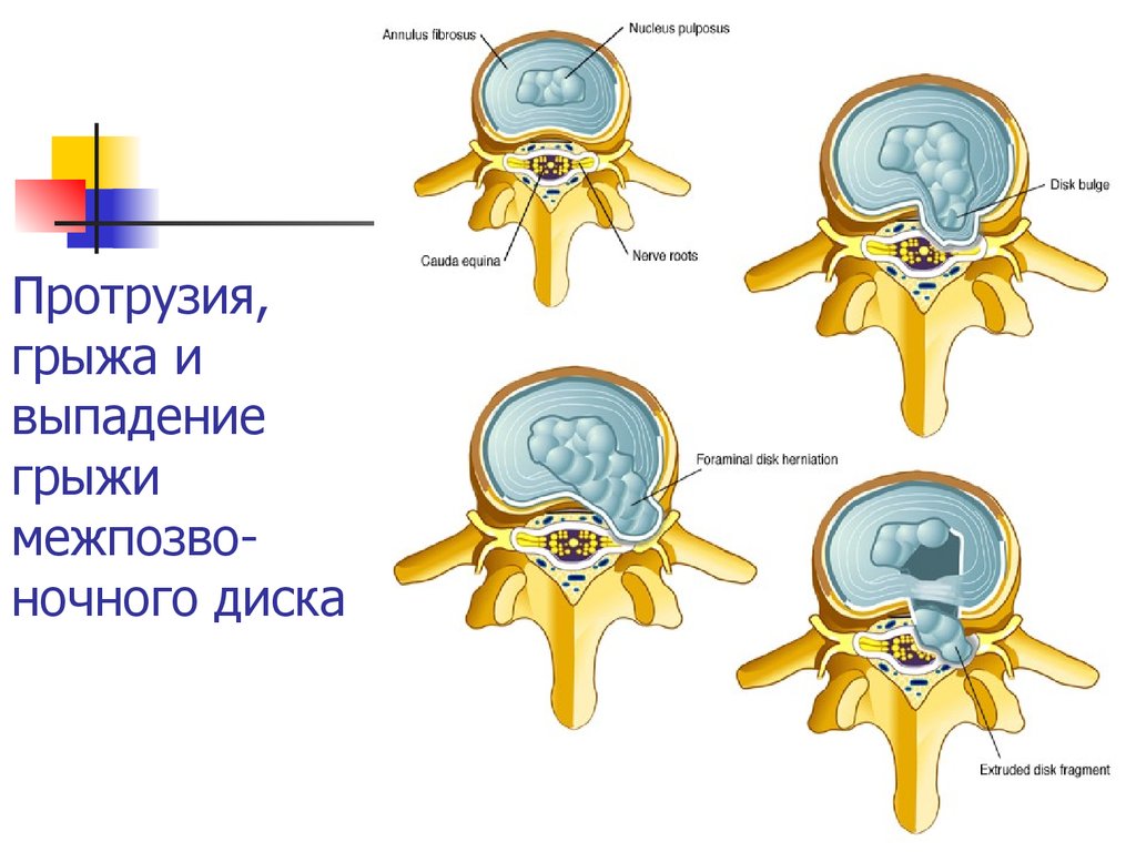 Протрузия. Медианная протрузия диска. Грыжа диска и протрузия диска. Протрузии схема. Протрузии межпозвонковых дисков.