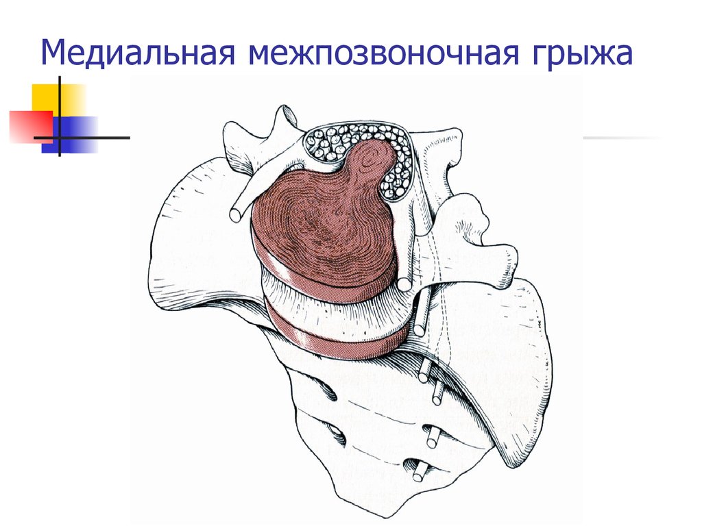 Парамедиальная грыжа позвоночника. Грыжа позвоночника диска медиальная. Медиально парамедиальная грыжа диска. Медианная грыжа позвоночника поясничного отдела. Медиально-парамедиальная грыжа l5/s1.