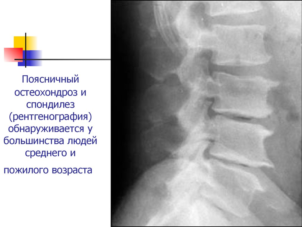Деформирующий спондилез фото