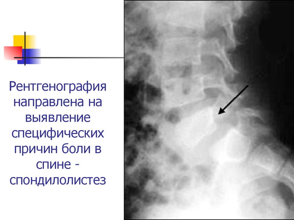 Рентгенография направлена на выявление специфических причин боли в спине - спондилолистез